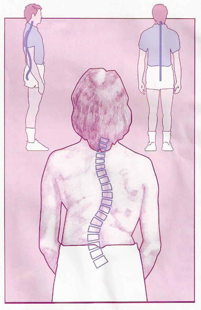 The spine has 3 slight curves: Neck Upper back Lower back Side view - Normal Back view