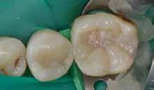 restoration in need of replacement Excavated tooth prepared for filling