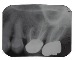 Limited To Endodontics Newsletter LTE Limited To Endodontics A Practice Of Endodontic Specialists June 1 2011 Volume 4 Endodontic Treatment Utilizing 3D Imaging Recent advances in technology, such as