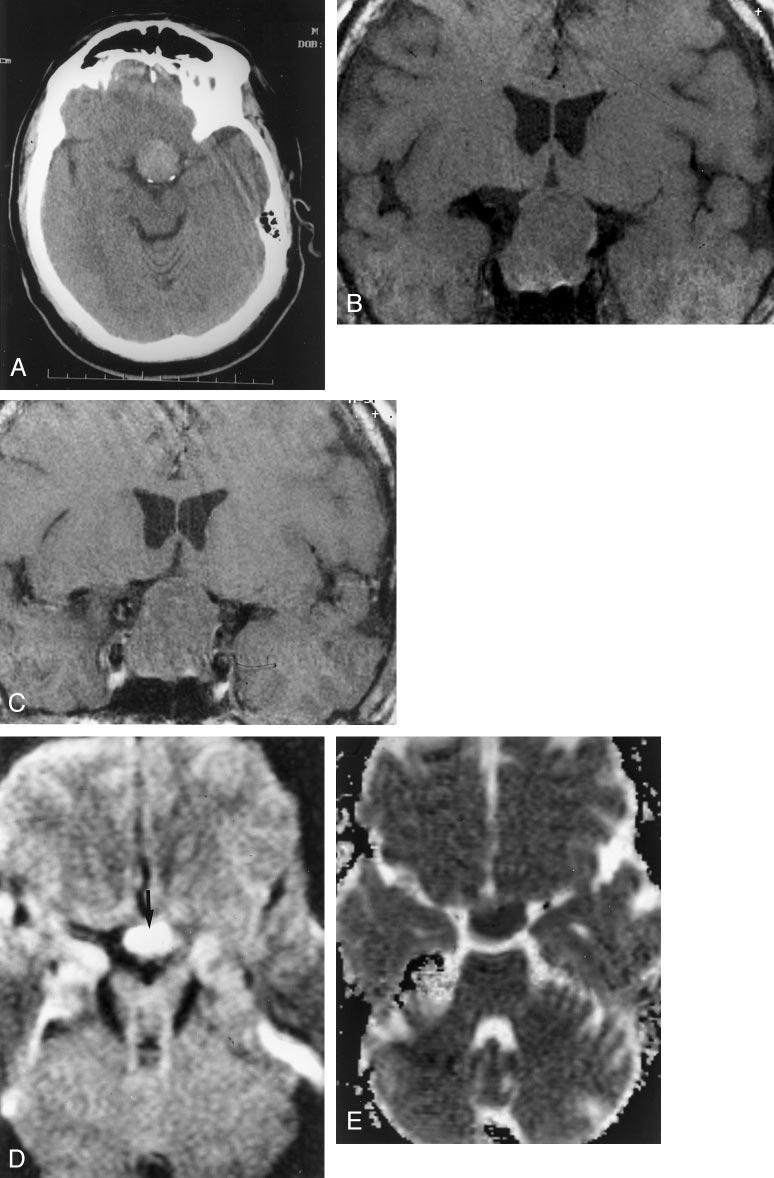 AJNR: 23, August 2002 PITUITARY APOPLEXY 1241 FIG 1. The case of a 57-year-old man who presented with decreased vision in his right eye.