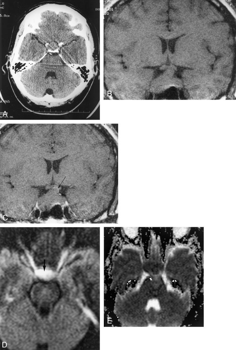 1242 ROGG AJNR: 23, August 2002 FIG 2. The case of a 40-year-old man who awoke with severe bilateral retro-orbital pain.