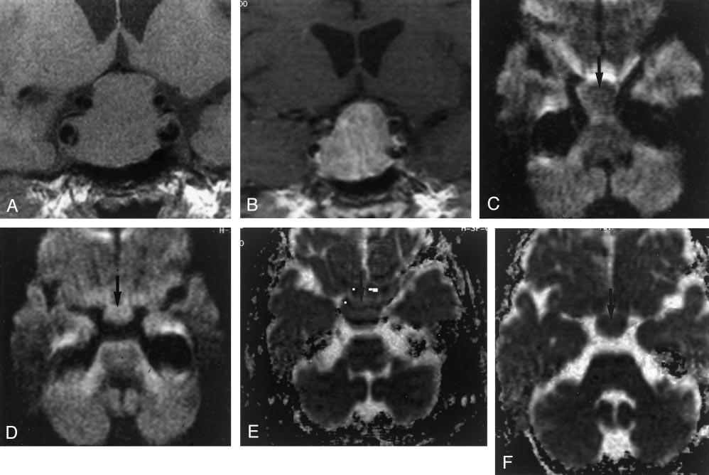 AJNR: 23, August 2002 PITUITARY APOPLEXY 1243 FIG 3. The case of a 64-year-old man with histologically confirmed pituitary adenoma without evidence of hemorrhage or infarction.