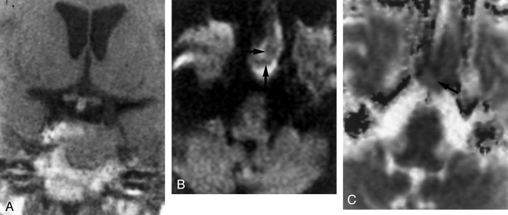 B, Coronal spin-echo T1-weighted MR image (500/20) shows diffuse uniform enhancement after the administration of contrast medium (0.05 mmol/kg).