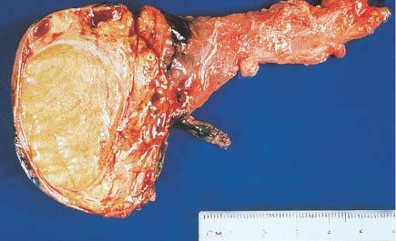 Gross appearance of granulomatous orchitis.