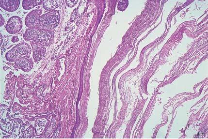 Microscopic appearance of epidermoid cyst of testis.