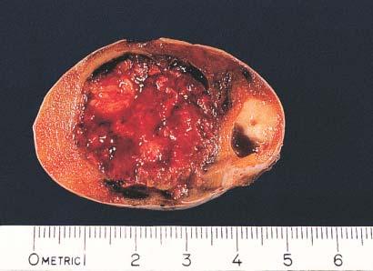 Gross appearance of combined tumor of testis.