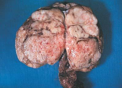 Gross appearance of combined tumor of testis.