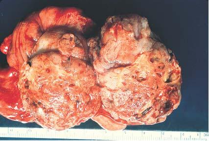 Embryonal carcinoma showing solid nodular cut