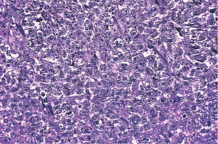 Embryonal carcinoma. The pattern of growth is diffuse but without the nesting seen in classic seminoma.