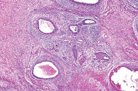 Immature teratoma.. Microscopic appearance.