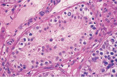 Microscopic appearance of intratubular germ cell neoplasia in routinely stained section.