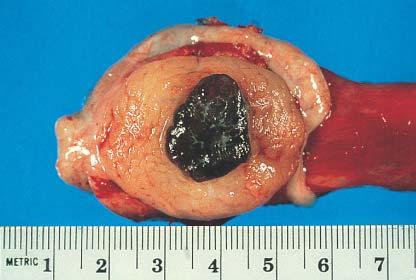 Gross appearance of Leydig cell tumor.