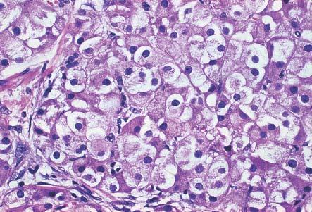 Leydig cell tumor of testis.