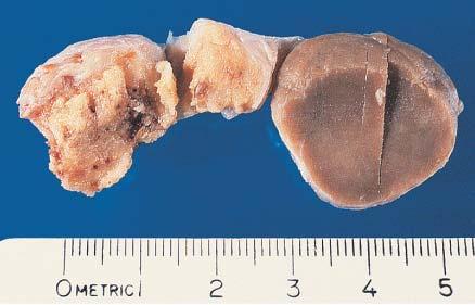 Gross appearance of large cell calcifying Sertoli cell tumor of testis.