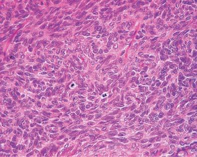 Adult form of granulosa cell tumor involving testis.