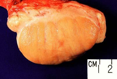 Gross appearance of malignant lymphoma of large