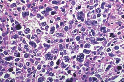 Cases of large B-cell B lymphoma with pleomorphic features such as that