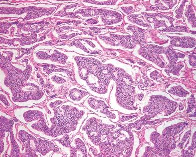 Intratesticular carcinoid tumor