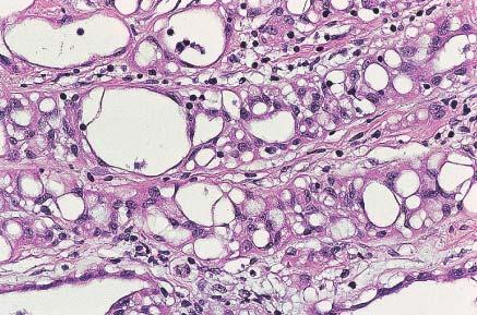 On high power, some of the tubules of adenomatoid tumor are lined by cuboidal cells,