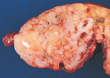 Gross appearance of teratocarcinoma.