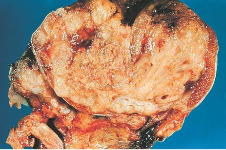 Gross appearance of teratocarcinoma.