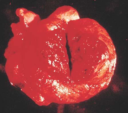 Gross appearance of pure choriocarcinoma.