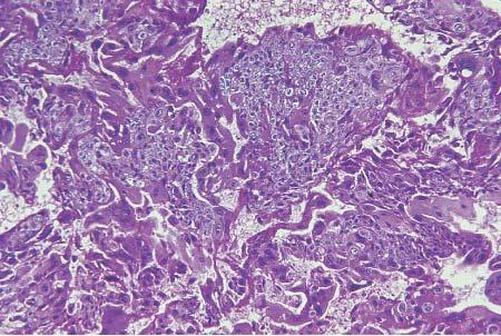 Microscopic appearance of testicular choriocarcinoma.