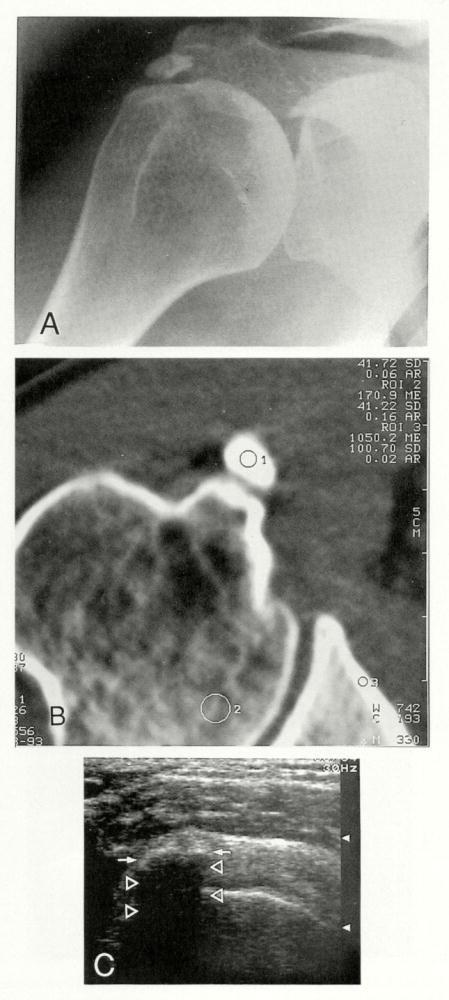 Consistency of Rotator Cuff Calcifications: Observations on Plain Radiography, Sonography, Computed Tomography, and at Needle Treatment. FARIN, PEKKA Investigative Radiology. 31(5):300 304, May 1996.