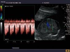 Fetal renal flow: Advanced Dynamic Flow shows flow in the