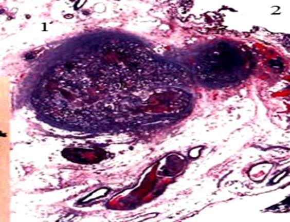 27,65 16 28,57 LymphonodusesGerota- lymph nodes located in the mesorectum. Figure9. Metastases in the lymph nodes of the mesorectum Figure10. The same patient. Histological picture.