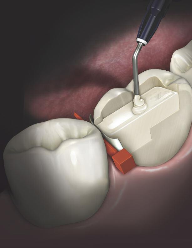 Flowable posterior composite Faster, esthetic posterior restorations. Simplified.