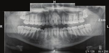 On examination there was a crack in the tooth which had occurred at an angle and was inclined towards the root of the tooth. An OPG was taken (Fig. 2). FIG.