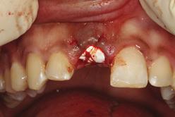Procedures 1.Implant placement Scandonest 3% was employed with 1.8ml buccal infiltration and Articaine 4% 1:100,000 adrenalin 1.8ml buccal infiltration and 1.8ml palatal infiltration.