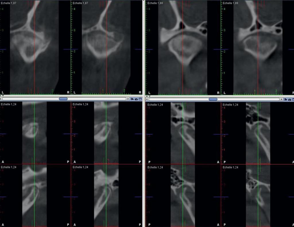 L. PETITPAS Additional assessments were performed by combining CBCT with digital models and by superimposing CBCTs