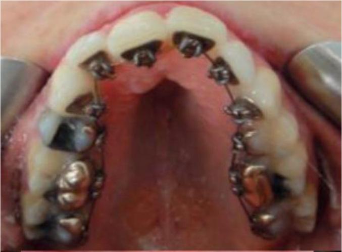 The orthodontic preparation is then performed using a fixed, vestibular mandibular, and maxillary lingual technique.
