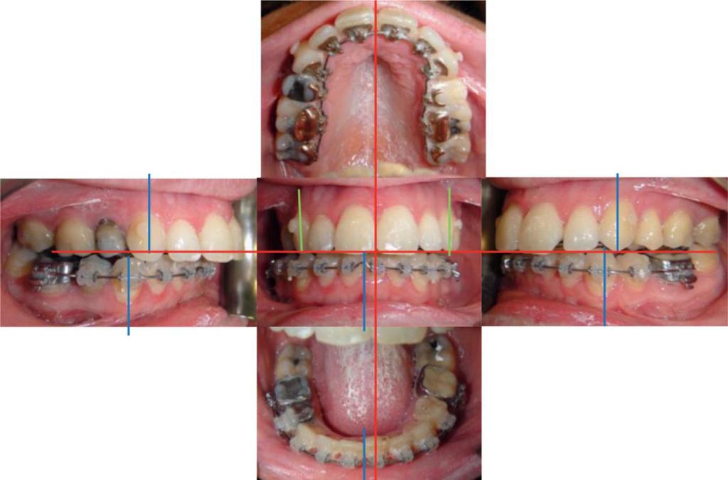 Combined use of digital imaging technologies: ortho-surgical treatment Figure 9 Intraoral pictures after