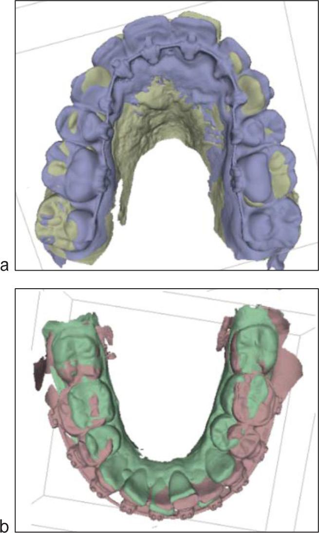 L. PETITPAS Figure 11 a) Digital superimposition before treatment and after orthodontic preparation of the maxilla.