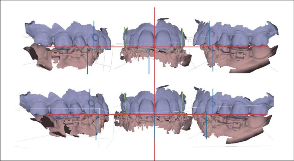 Figure 12 Digital simulation of the surgical effects with simulation of post-surgical occlusion: restoration of class