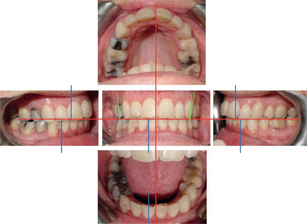 L. PETITPAS Figure 15 Intraoral pictures after treatment. Centered medians; bilateral dental class I obtained.