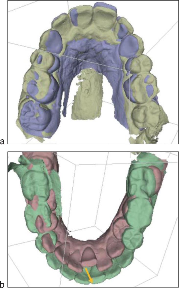 Figure 16 a) Superposition before and after maxillary treatment. b) Superposition before and after mandibular treatment.