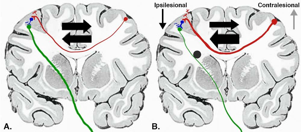 Interhemispheric competition model of stroke recovery Stroke induces local and global cortical reorganization Increased contra and
