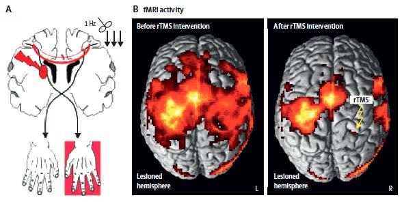 rtms can modulate abnormal brain activity after stroke Grefkes and