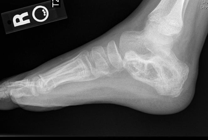 Case #1 8 year old male Presented with a 1-year history of R heel pain