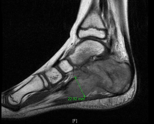 clinic Xray R foot was read as abnormal (likely osteomyelitis or primary