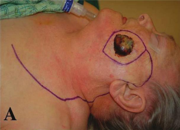 2 Journal of Skin Cancer (a) (a) (b) (b) (c) (c) Figure 1: Macroscopic appearance of Merkel cell carcinoma.