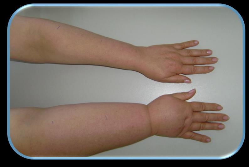 Secondary arm lymphedema (SALE) after breast cancer treatment abnormal accumulation of interstitial