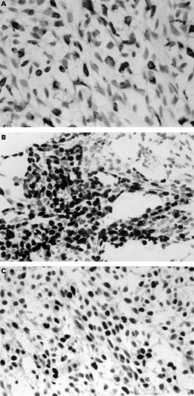 554 McCluggage, Primrose, Toner Figure 2 (A) Positive immunohistochemical staining of myoepithelial carcinoma with AE1/AE3.
