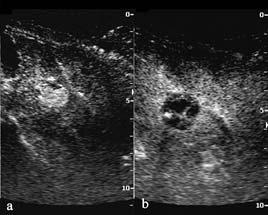 Color and Power Doppler US with or without the use of first generation contrast agents are not sensitive enough to differentiate vascularized viable tumor from ablated tissue [15-18].