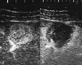 Contrast enhanced ultrasound in assessing therapeutic response in ablative treatments of hepatocellular carcinoma 245 the gold standard in assessing the ablation results has not in fact a 100%