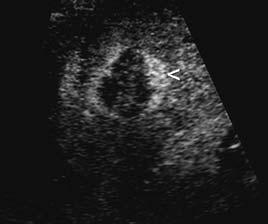 Contrast enhanced ultrasound in assessing therapeutic response in ablative treatments of hepatocellular carcinoma 247 (or dynamic gadolinium enhanced MRI) is the mainstay for imaging of treated